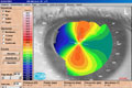 Topografía Corneal CSO